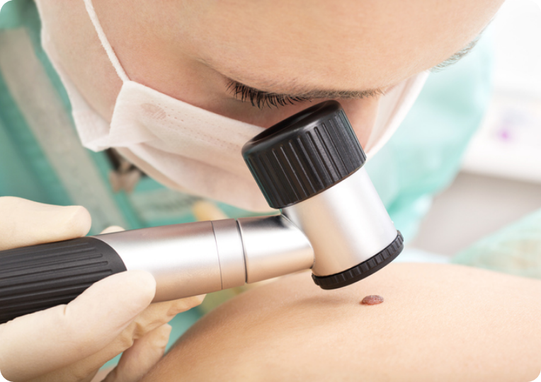 Read more about the article Identificando um melanoma através do critério ABCDE